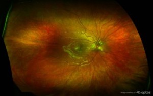 Lakeshore Eyecare Center Retinal Exam